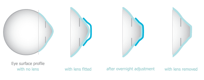 How Ortho-K reshapes the cornea overnight
